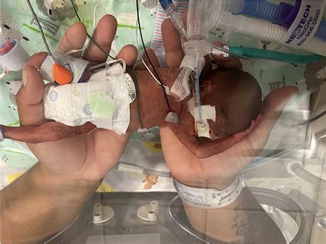 Born 8 weeks early Born 8 weeks early