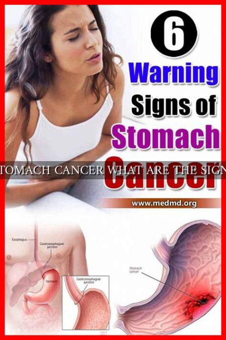 Stomach Cancer What Are The Signs Wadaef