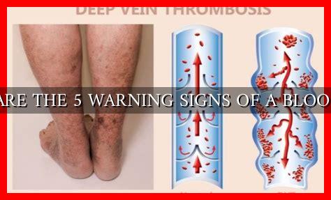 WHAT ARE THE 5 WARNING SIGNS OF A BLOOD CLOT WHAT ARE THE 5 WARNING SIGNS OF A BLOOD CLOT