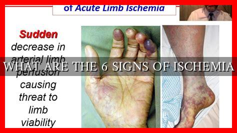 WHAT ARE THE 6 SIGNS OF ISCHEMIA WHAT ARE THE 6 SIGNS OF ISCHEMIA