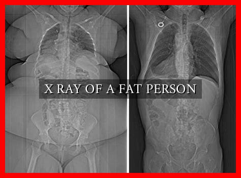 X RAY OF A FAT PERSON - Wadaef