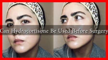 Can Hydrocortisone Be Used Before Surgery