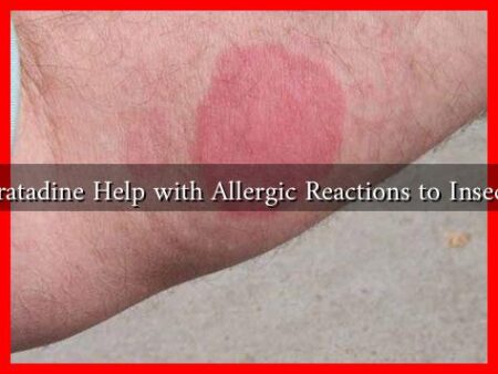 Can Loratadine Help with Allergic Reactions to Insect Bites?