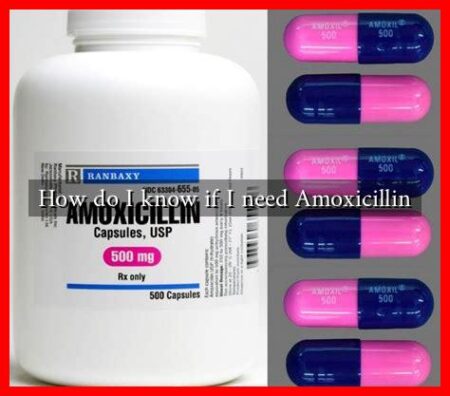 How do I know if I need Amoxicillin How do I know if I need Amoxicillin