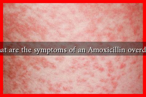 What are the symptoms of an Amoxicillin overdose What are the symptoms of an Amoxicillin overdose